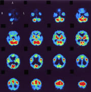図6･3 123I-IMPを用いたアルツハイマー病の画像